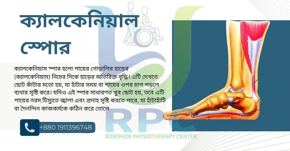 ক্যাল্কেনিয়াস স্পোর : পায়ের গোরালির ব্যথা