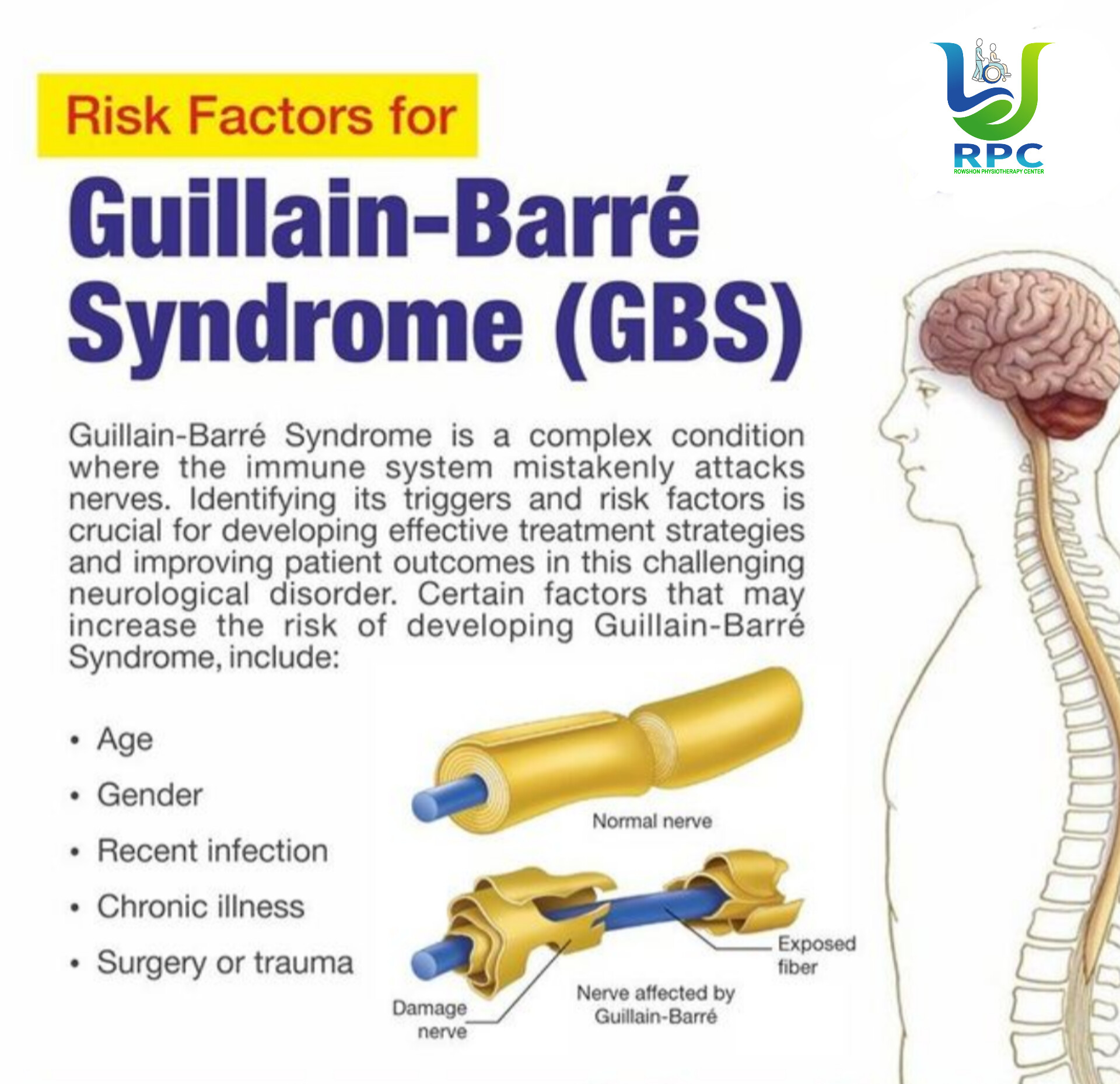 গিলিয়ান–বারে সিন্ড্রোম (Guillain-Barré Syndrome): কারণ, লক্ষণ ও ফিজিওথেরাপি ব্যবস্থাপনা