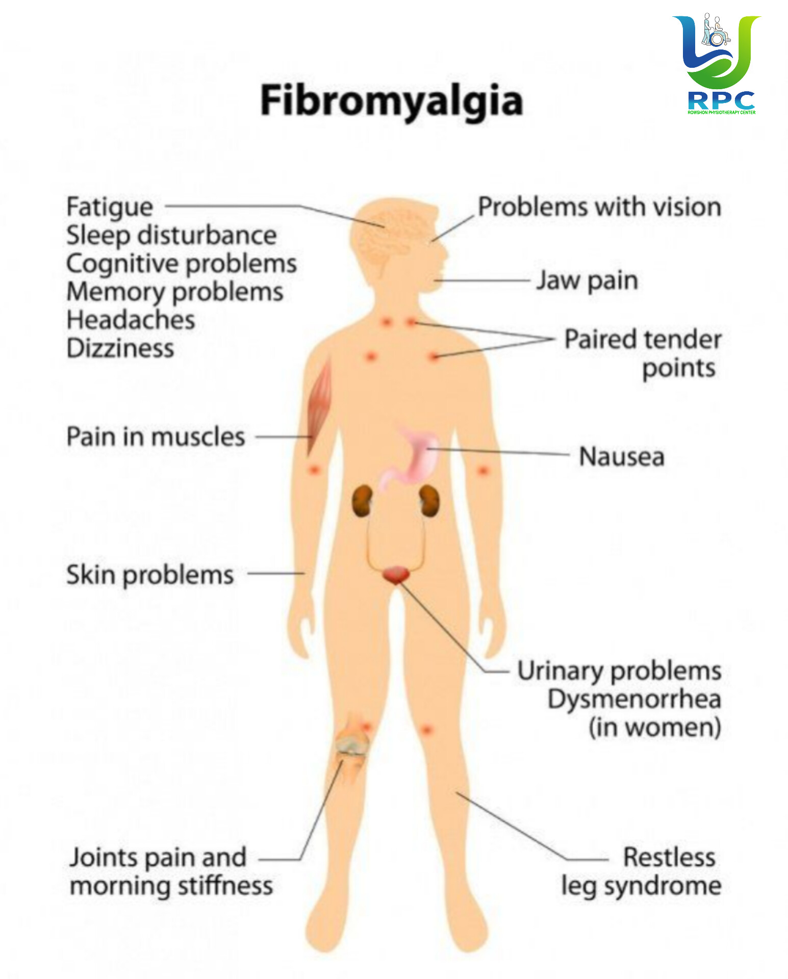 Fibromyalgia: কারণ, লক্ষণ ও ফিজিওথেরাপির ভূমিকা