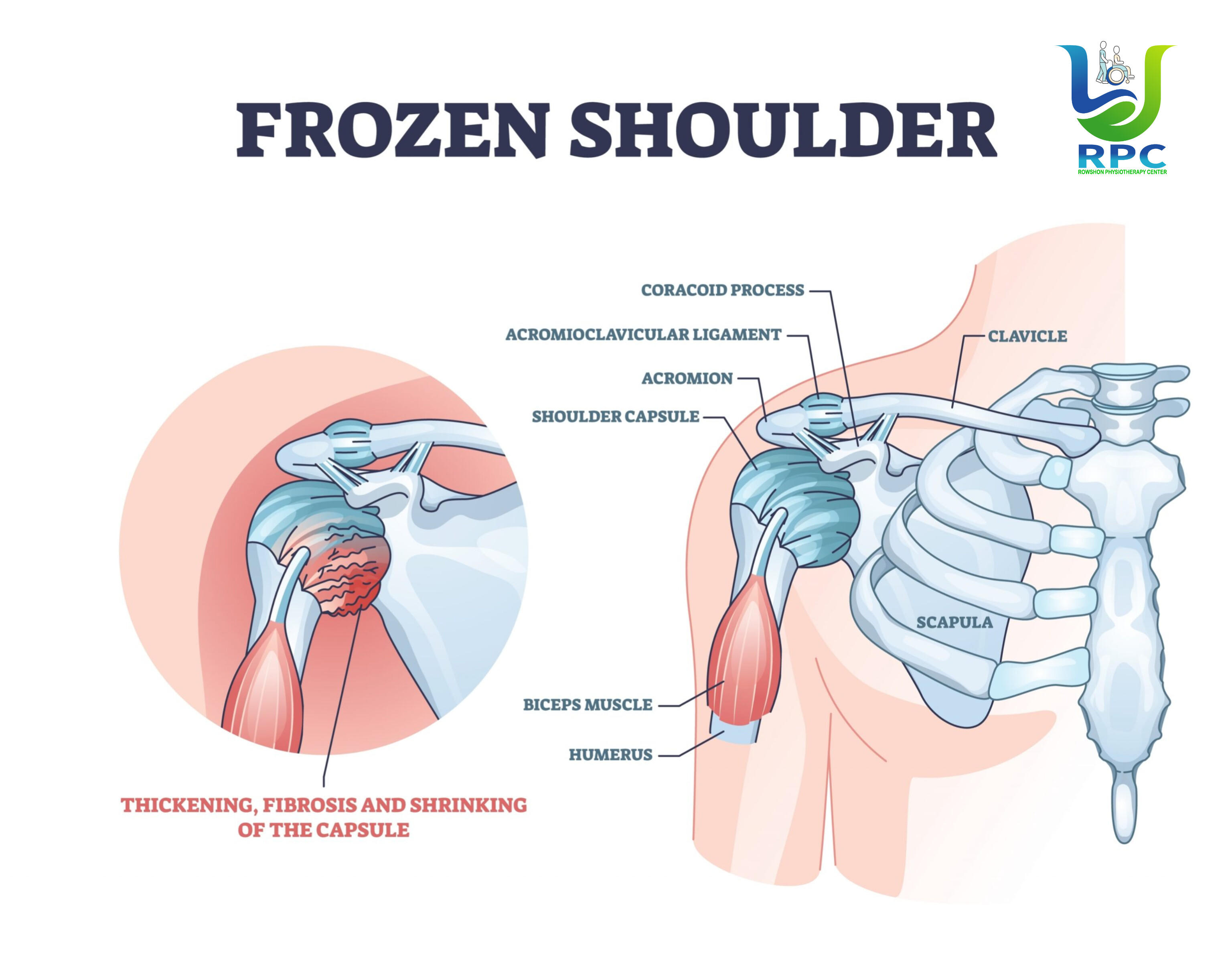 ফ্রোজেন শোল্ডার (Frozen Shoulder): কারণ, লক্ষণ ও ফিজিওথেরাপি চিকিৎসা